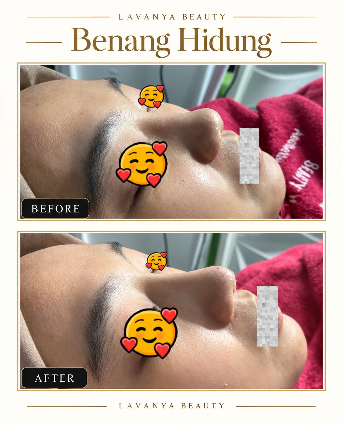 Perbandingan sebelum dan sesudah Benang Hidung