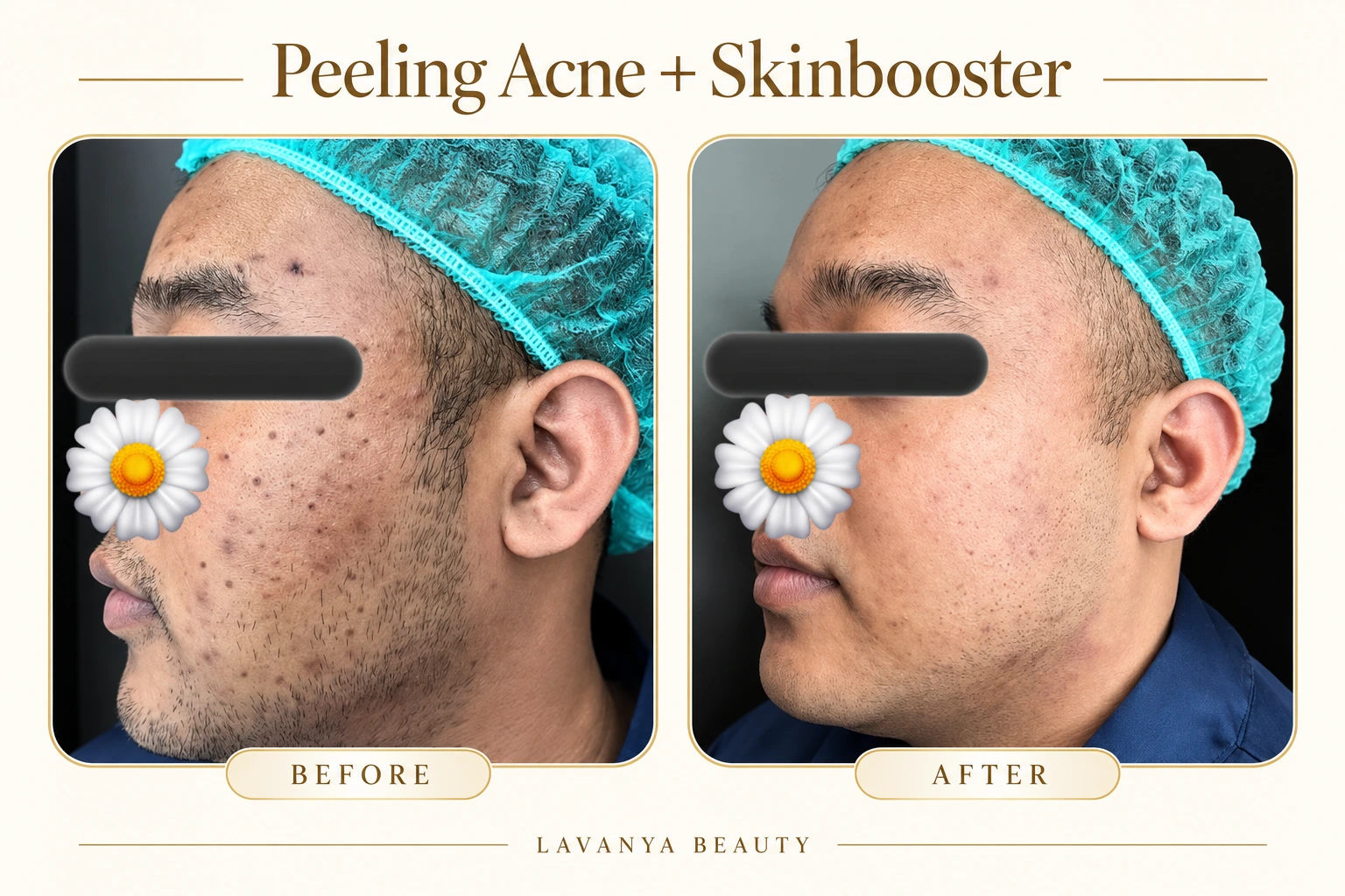 Perbandingan sebelum dan sesudah Peeling Acne + Skinbooster