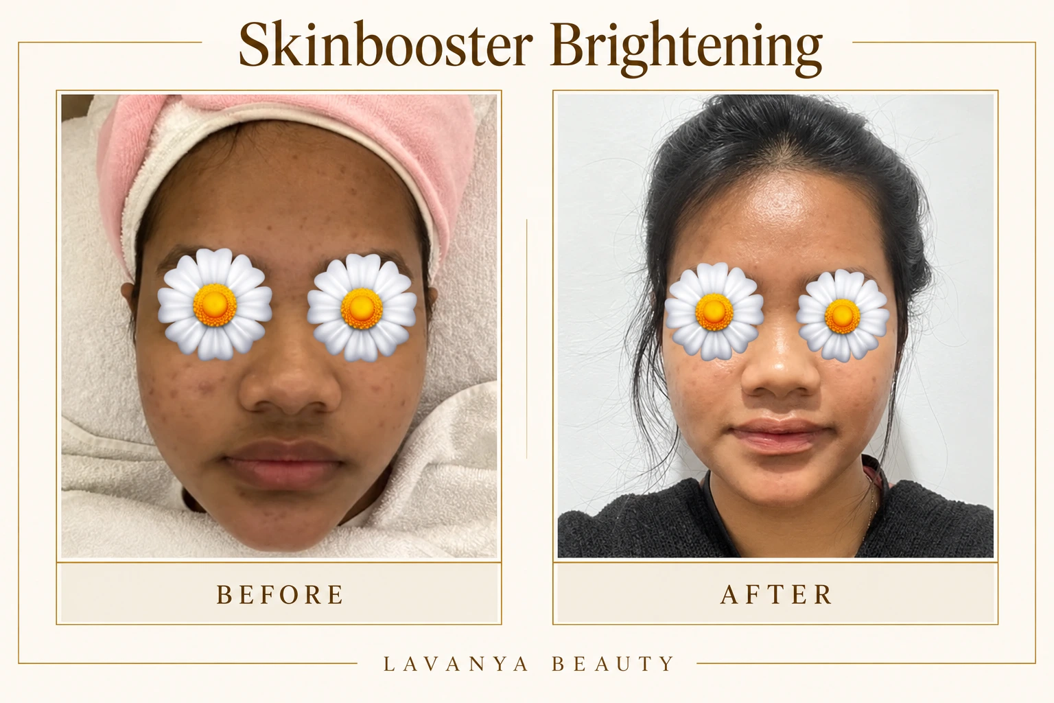 Perbandingan sebelum dan sesudah Skinbooster Brightening