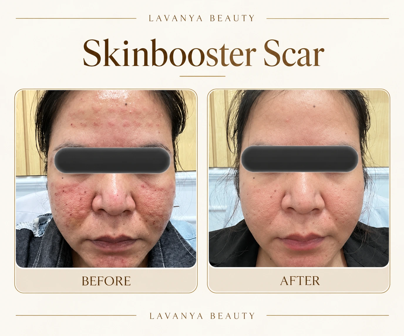 Perbandingan sebelum dan sesudah Skinbooster scar